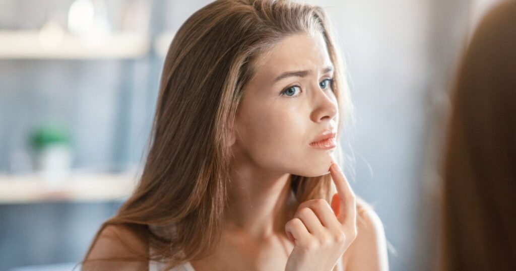 why-do-i-have-pimples-on-my-chin-and-how-to-get-rid-of-them-marathikayda